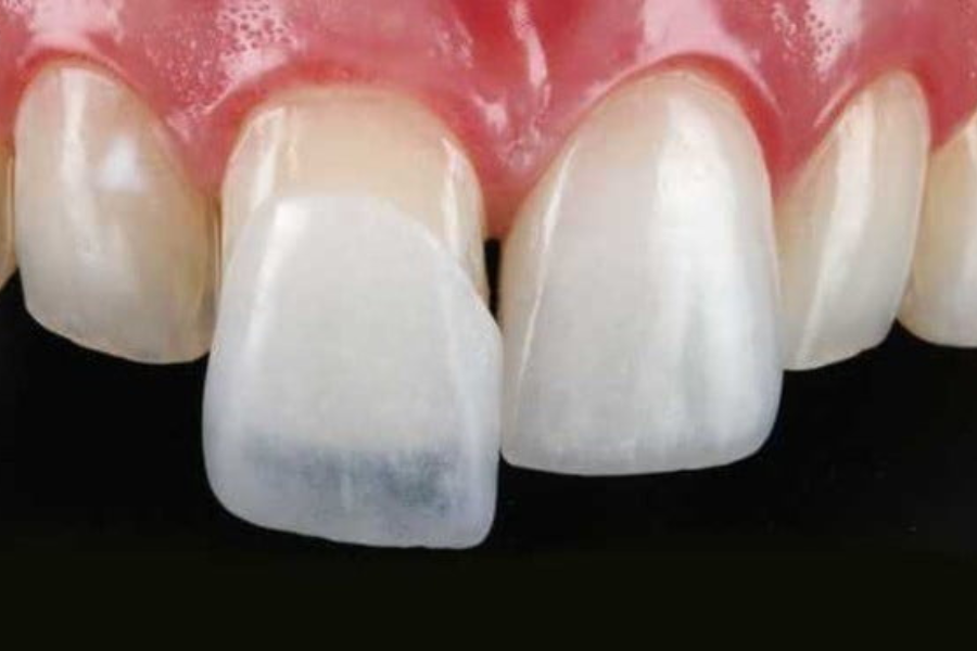 Lentes de Contato Dental em Curitiba: O Toque Final de Sofisticação para o Seu Sorriso