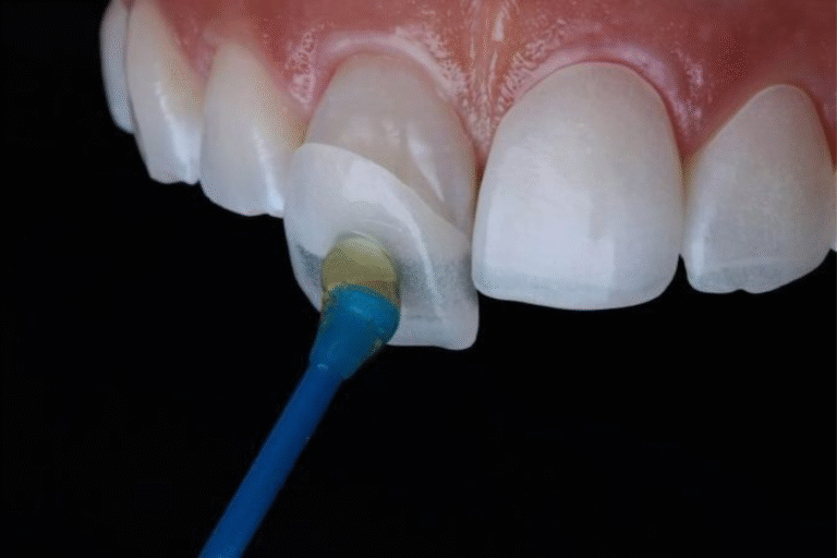 Lentes de Contato Dental: Mitos e Verdades