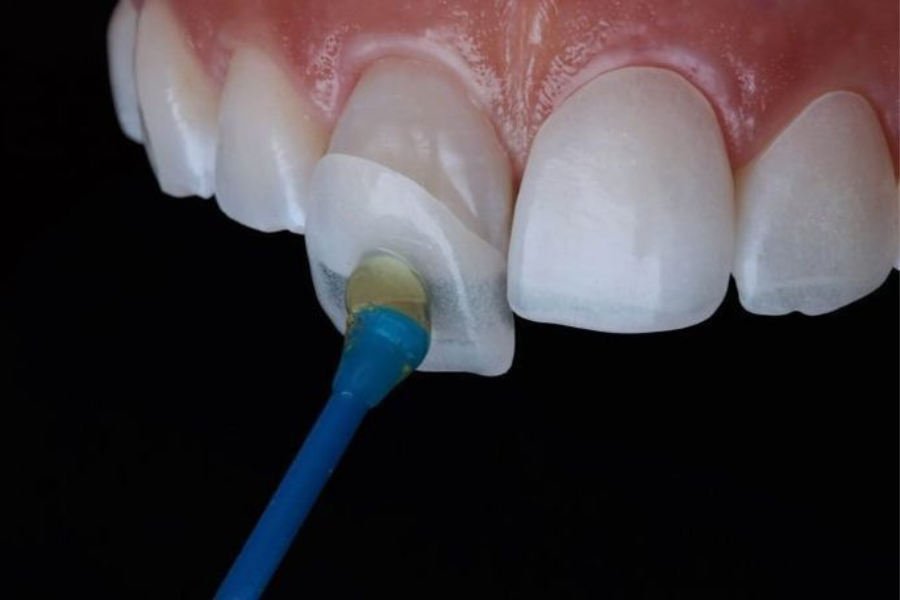 Lentes de Contato Dental: Mitos e Verdades