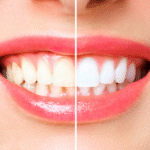Como Clarear os Dentes com Segurança: Técnicas e Cuidados