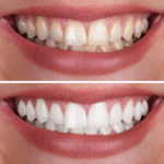 Como Conquistar um Sorriso Branco Curitiba