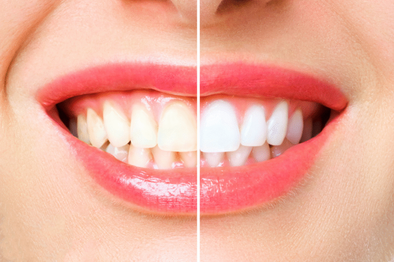 Como Clarear os Dentes com Segurança: Técnicas e Cuidados